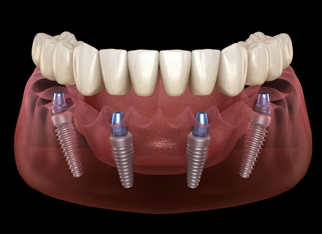 All On 4 Dental Implants Scottsdale, AZ
